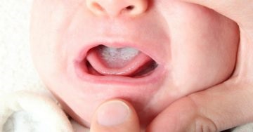 Candida tünetei mandulagyulladás gyermekek és felnőttek, kezelés, fotók