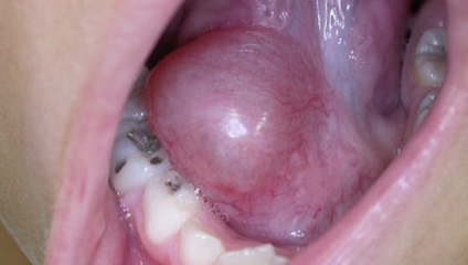 A ciszta a szájban - egy fotó a leírás valós klinikai esetek