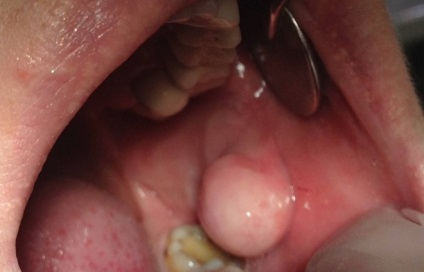 A ciszta a szájban - egy fotó a leírás valós klinikai esetek