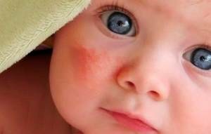 Червоні плями на обличчі фото, причини та способи лікування