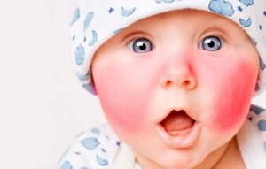 Piros arca, amikor fogzás gyerek - fénykép okoz bőrpírt