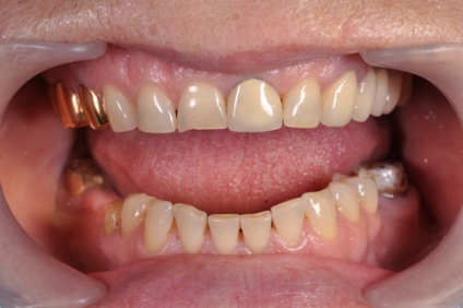 Cast korona (Solid fogak) típusok, az ár a protézisek, előnyök