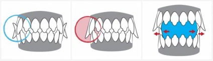 Malocclusion kölyök fajta, okai és megszüntetésük