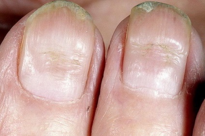 nail betegségnek a kezében gombák