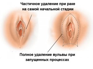 Onkológiai nemi szerv megcsonkítása a nők és a férfiak, a rák - kezelésére és megelőzésére (nők) Onkológiai nemi szerv megcsonkítása a nők és a férfiak, a rák - kezelésére és megelőzésére