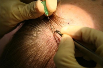 Hajátültetés műtét - módszer kiválasztásában