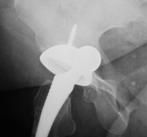 Jellemzők Revision arthroplasty evőkanál (audit) Jellemzők Revision arthroplasty evőkanál