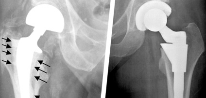 Jellemzők Revision arthroplasty evőkanál (audit) Jellemzők Revision arthroplasty evőkanál