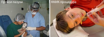 Az akut rhinosinusitis mi ez, tünetei és kezelése (tünetek) Az akut rhinosinusitis mi ez, tünetei és kezelése