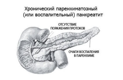 Hasnyálmirigy-parenchyma típusok, prognózis, tünetei, kezelése