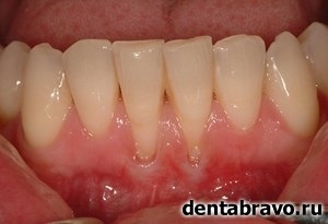 periodontális betegségek kezelésére diabetes)