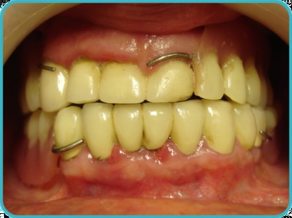 A periodontális betegség oka a felnőttek öröklődés, a fertőzés