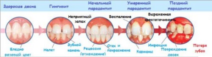 A periodontális betegség oka a felnőttek öröklődés, fertőzés (ok) A periodontális betegség oka a felnőttek öröklődés, a fertőzés