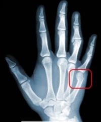Törés a kis ujját a kéz jeleket, mint a gyógyulás, a kezelés