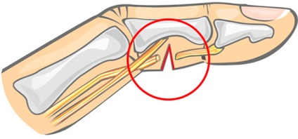 Törés a kis ujját a kezét egy műszak kezelés, a tünetek és a rehabilitációs