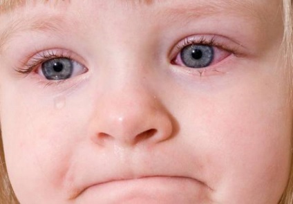 Чому гниють очі у дитини причини і способи лікування