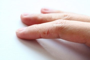 Miért száraz és repedezett bőr a kézen