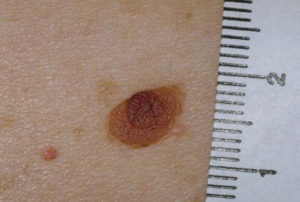 Border nevus pigmentosa ez szövettani, okok és a tünetek (határ) Border anyajegyet pigmentosa azt szövettan, okai és tünetei