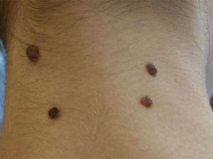 Border nevus pigmentosa ez szövettani, okok és a tünetek (okok) Border anyajegyet pigmentosa azt szövettan, okai és tünetei