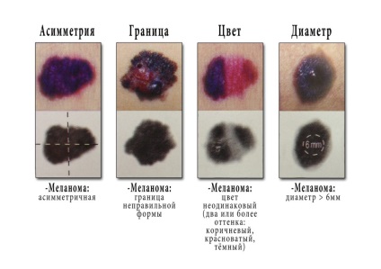 Border nevus pigmentosa ez szövettani, okok és a tünetek (okok) Border anyajegyet pigmentosa azt szövettan, okai és tünetei
