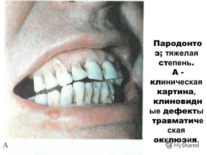 Előadás a fogágybetegség és a fogágy