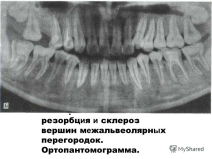 Előadás a fogágybetegség és a fogágy