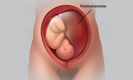 Az okok a polyhydramnion - értjük az összes olyan ijesztő és hogyan kell megváltoztatni