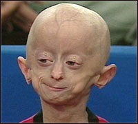 Progeria vagy idő előtti öregedés szindróma, a honlap azok számára, akik több mint negyven