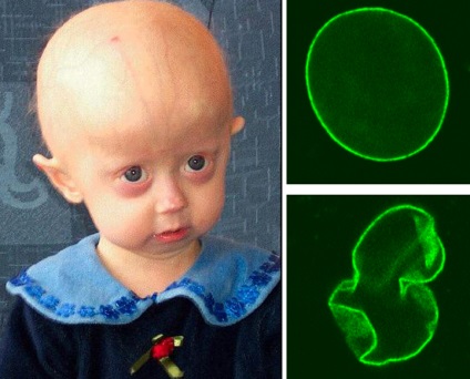 Progeria vagy idő előtti öregedés szindróma, a honlap azok számára, akik több mint negyven