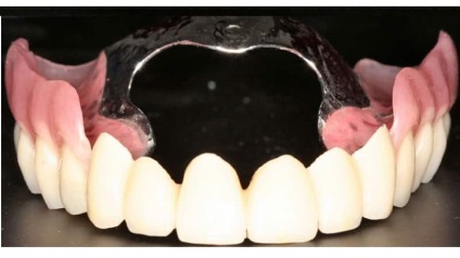 Protézis periodontitissel és a fogágy vélemények immplantatsii