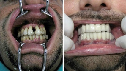 Protézis periodontitissel és a fogágy vélemények immplantatsii