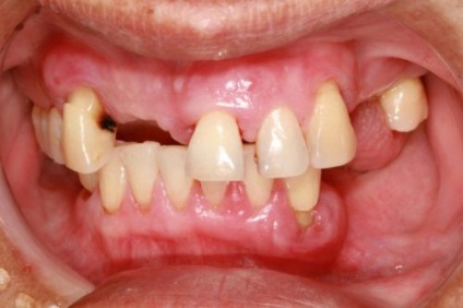 Protézis periodontitis, lehetséges, hogy az implantátumok, a legjobb