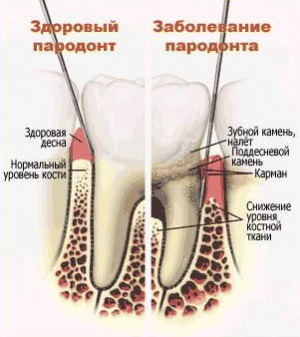 Protézis at parodontosist 1