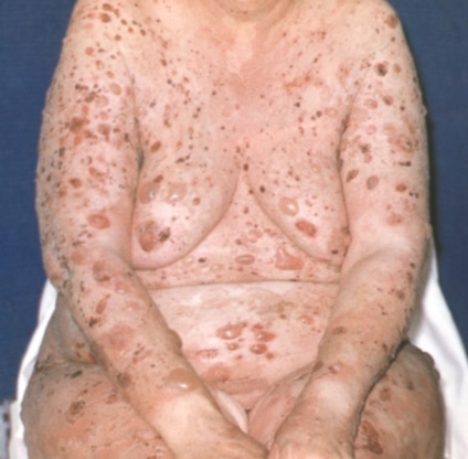 Pemphigus vulgaris (vulgáris) okoz, a tünetek, diagnózis, kezelés