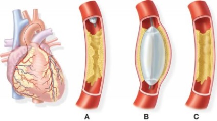 Rehabilitáció után stent beültetést hajók a szív