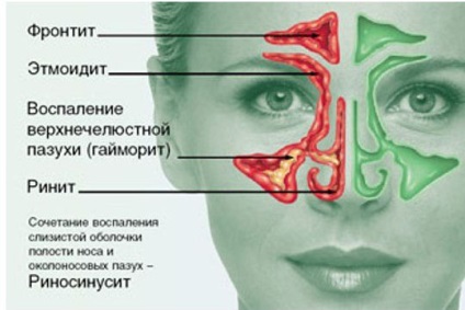 Rhinosinusitis azaz a tünetek az allergiás rinoszinuszitiszes és gyógyszeres