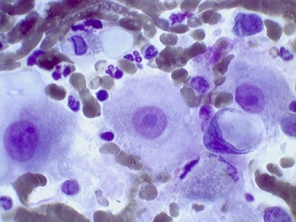 Leiomyosarcoma (rák az izomzatban): tünetek, okok, kezelés - Rák - 2021