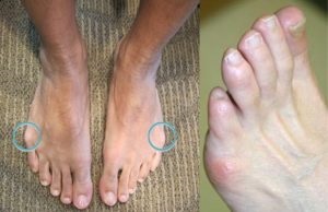 Bump a lábát kisujj okok és a kezelés