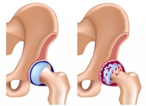 Modern kezelési módszerek a csípő osteoarthritis