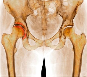 Modern kezelési módszerek a csípő osteoarthritis