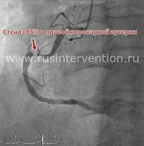 A koszorúér-stent beültetést - Magyar Kardiológiai Tudományos Termelési kopmleks (koszorúér stenting) A koszorúér-stent beültetést - Magyar Kardiológiai Tudományos Termelési kopmleks