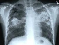A tuberkulózis Children - okai, tünetei, diagnózisa és kezelése