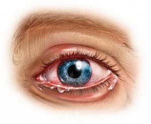 Uveitis a szem kezelésére orvosi drogok és népi jogorvoslati (kezelt szem uveitis) Uveitis a szem kezelésére orvosi drogok és népi jogorvoslati