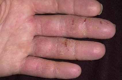 Típusai fotó dermatitis és ezen betegségek kezelésére (kezelés) Típusai fotó dermatitis és az ilyen megbetegedések kezelésére