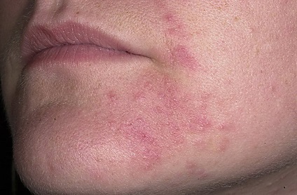 Típusai fotó dermatitis és ezen betegségek kezelésére (kezelés) Típusai fotó dermatitis és az ilyen megbetegedések kezelésére