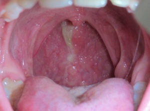 Пухирі в горлі причини появи і способи лікування