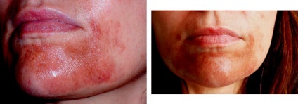 Lehetséges szövődmények után kémiai, lézer és más típusú peeling (kémiai) Lehetséges szövődmények után kémiai, lézer és más típusú hámlasztás
