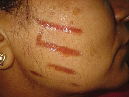 Lehetséges szövődmények után kémiai, lézer és más típusú peeling (szövődmények lehúzást követően) Lehetséges szövődmények után kémiai, lézer és más típusú hámlasztás