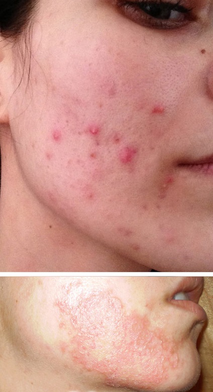 Lehetséges szövődmények után kémiai, lézer és más típusú peeling (szövődmények lehúzást követően) Lehetséges szövődmények után kémiai, lézer és más típusú hámlasztás