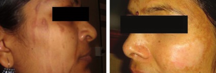 Lehetséges szövődmények után kémiai, lézer és más típusú peeling (szövődmények) Lehetséges szövődmények után kémiai, lézer és más típusú hámlasztás